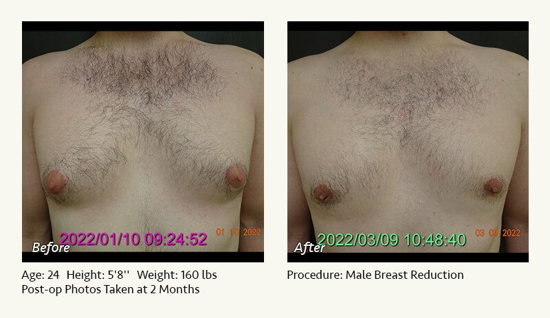 Male Breast Reduction Surgery in Plano, TX - Patient 13