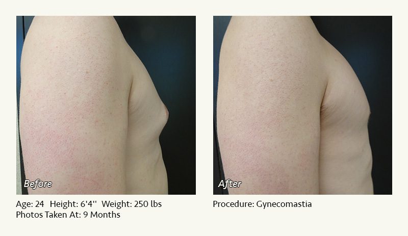 Male Breast Reduction Surgery in Plano, TX - Patient 12