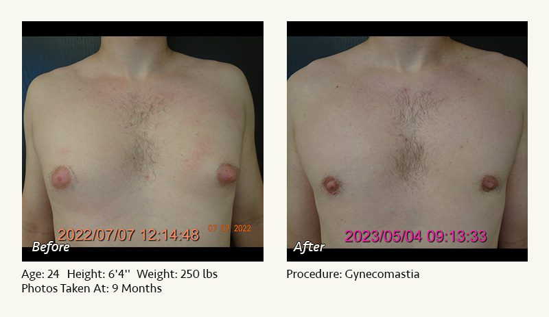 Male Breast Reduction Surgery in Plano, TX - Patient 11