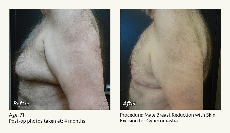 Male Breast Reduction Surgery in Plano, TX - Patient 2