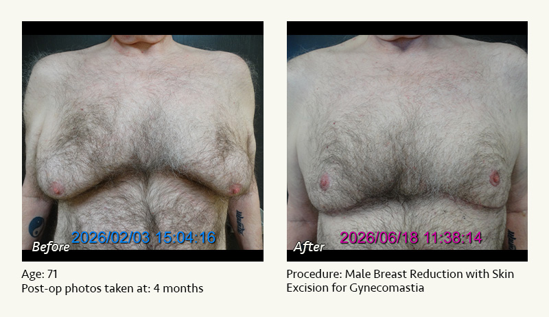 Male Breast Reduction Surgery in Plano, TX - Patient 1