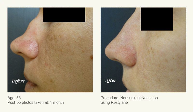 Restylane® & JUVÉDERM® Gel Injectable Fillers In Plano, TX - Patient 1