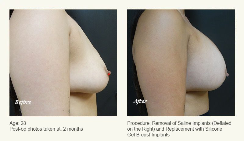 Breast Implant Revision in Plano, TX - Patient 2