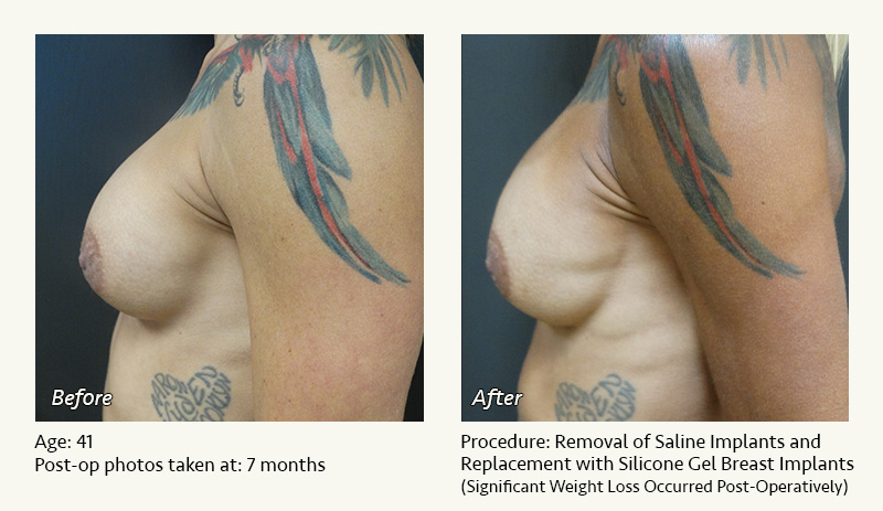 Breast Implant Revision in Plano, TX - Patient 2
