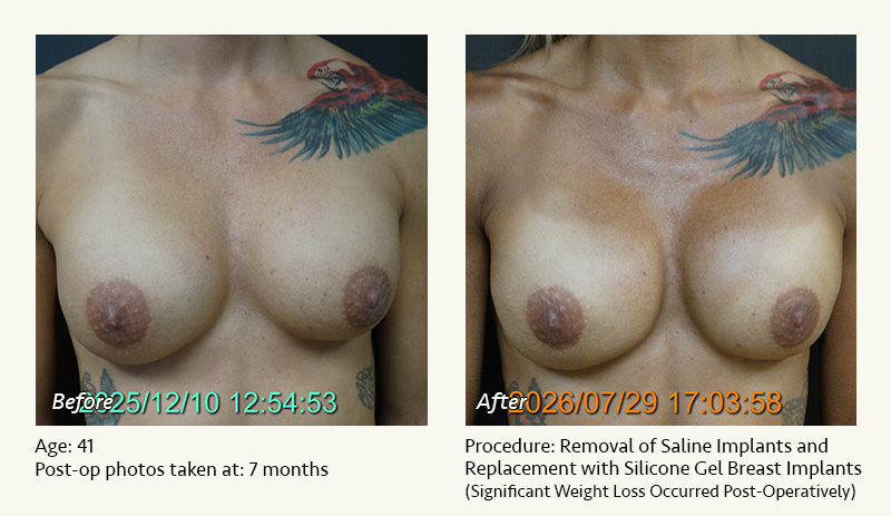 Breast Implant Revision in Plano, TX - Patient 1
