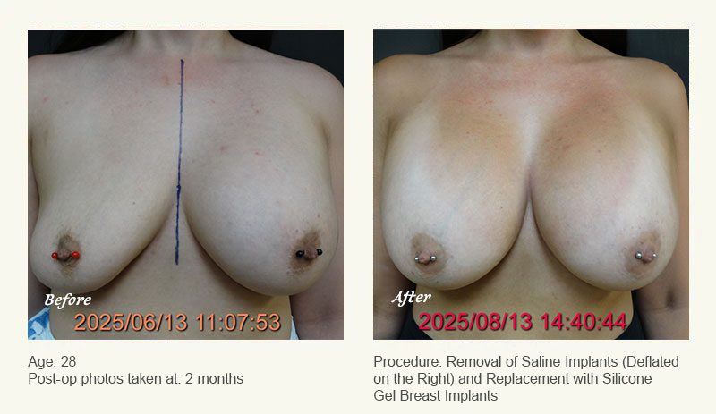 Breast Implant Revision in Plano, TX - Patient 1
