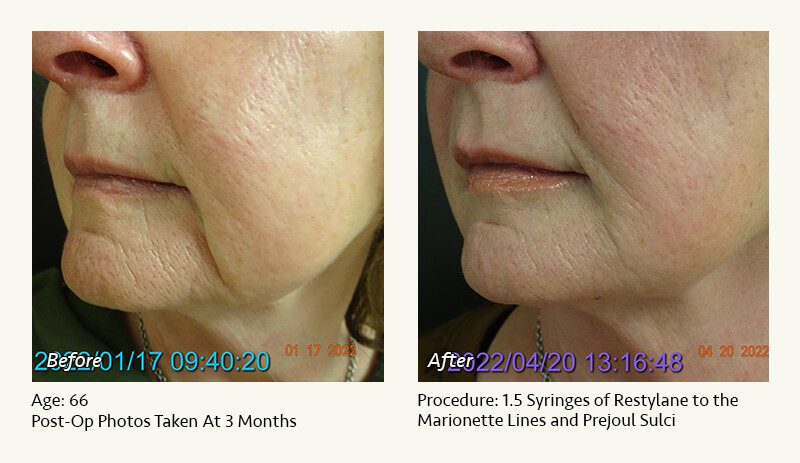 Restylane® & JUVÉDERM® Gel Injectable Fillers In Plano, TX - Patient 17
