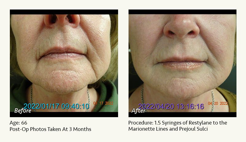 Restylane® & JUVÉDERM® Gel Injectable Fillers In Plano, TX - Patient 16