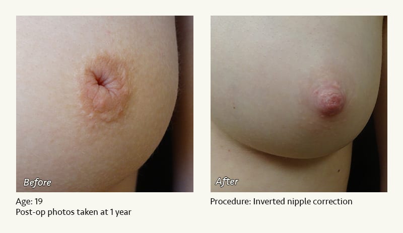 Nipple Procedures (Female) in Plano, TX - Patient 41