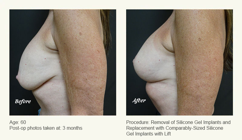 Breast Implant Revision in Plano, TX - Patient 2