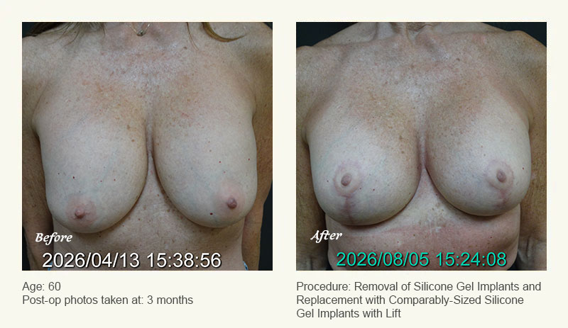 Breast Implant Revision in Plano, TX - Patient 1