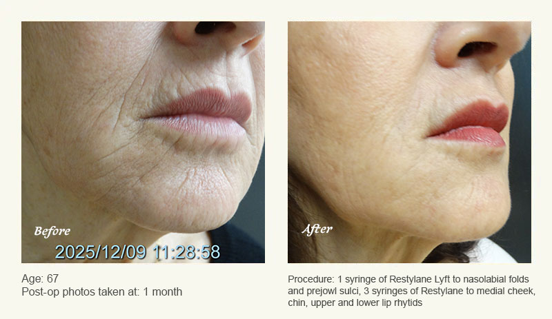 Restylane® & JUVÉDERM® Gel Injectable Fillers In Plano, TX - Patient 2