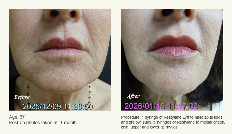 Restylane® & JUVÉDERM® Gel Injectable Fillers In Plano, TX - Patient 1