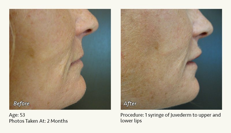 Restylane® & JUVÉDERM® Gel Injectable Fillers In Plano, TX - Patient 13
