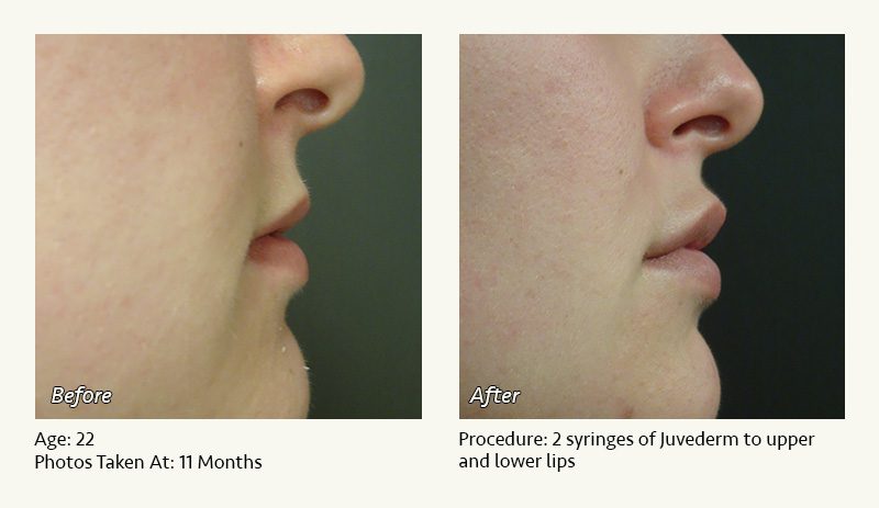Restylane® & JUVÉDERM® Gel Injectable Fillers In Plano, TX - Patient 11