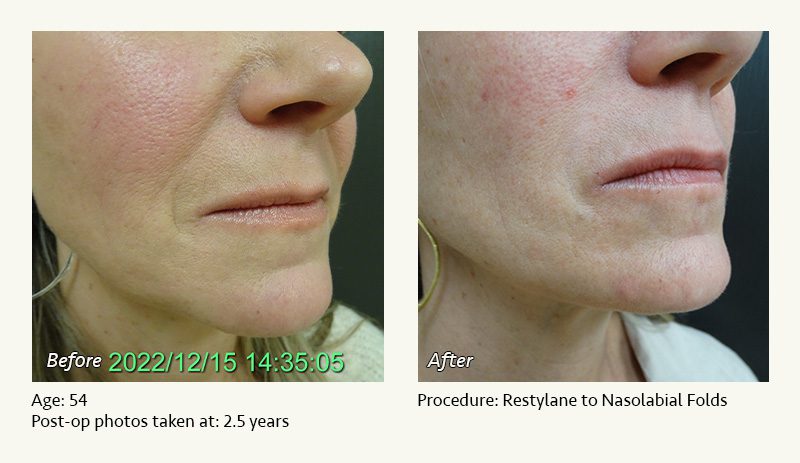 Restylane® & JUVÉDERM® Gel Injectable Fillers In Plano, TX - Patient 1