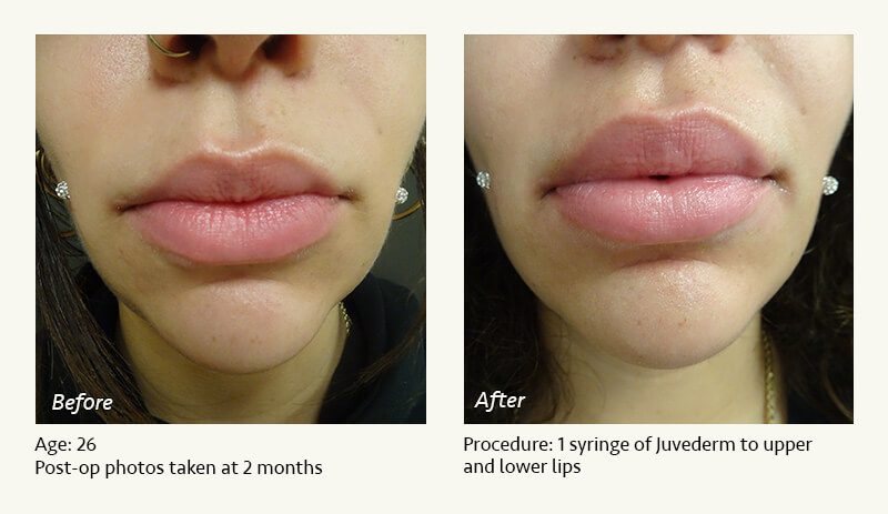 Restylane® & JUVÉDERM® Gel Injectable Fillers In Plano, TX - Patient 21