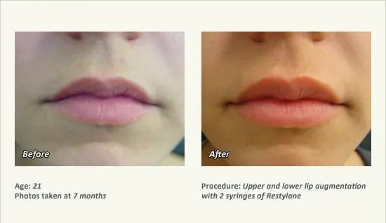 Restylane® & JUVÉDERM® Gel Injectable Fillers In Plano, TX - Patient 42
