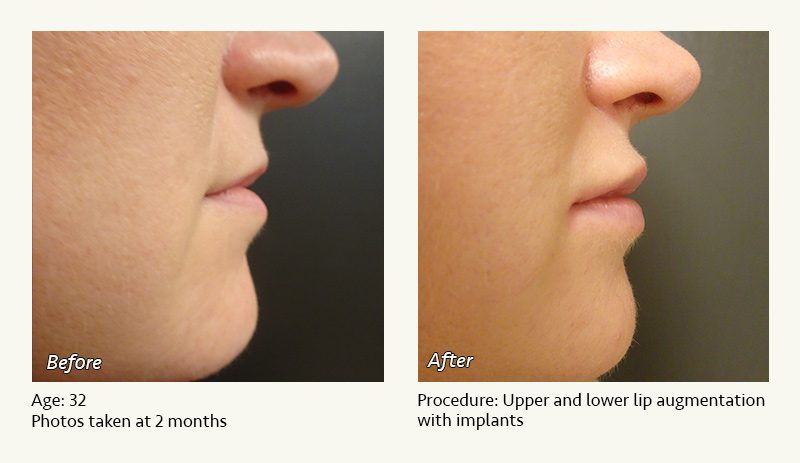Lip Augmentation in Plano, TX - Patient 4