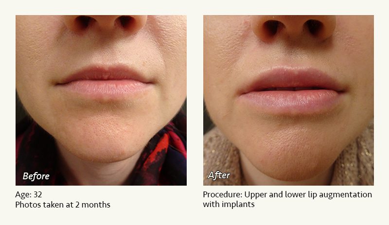 Lip Augmentation in Plano, TX - Patient 3