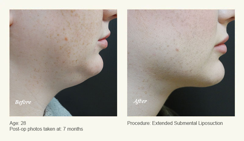 Chin Liposuction in Plano, TX - Patient 2