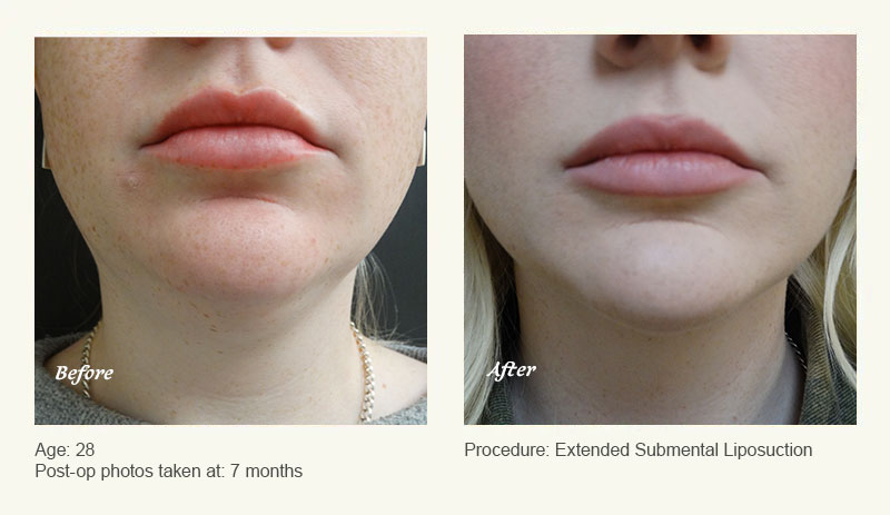 Chin Liposuction in Plano, TX - Patient 1