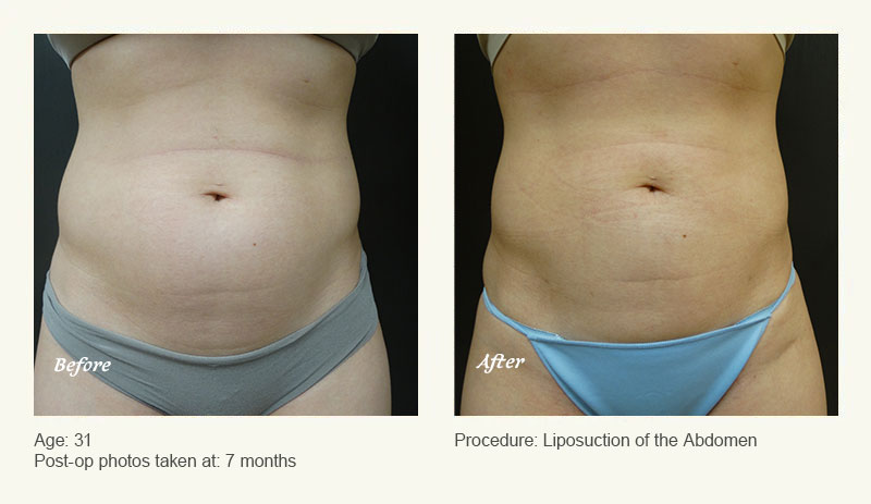 Liposuction Surgery in Dallas & Plano - Patient 1