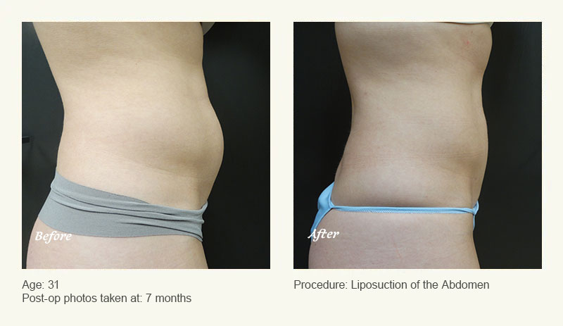 Liposuction Surgery in Dallas & Plano - Patient 2