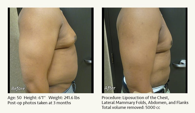 Male Liposuction Surgery - Patient 9