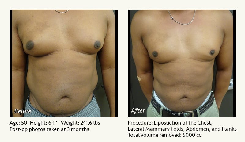 Male Liposuction Surgery - Patient 8