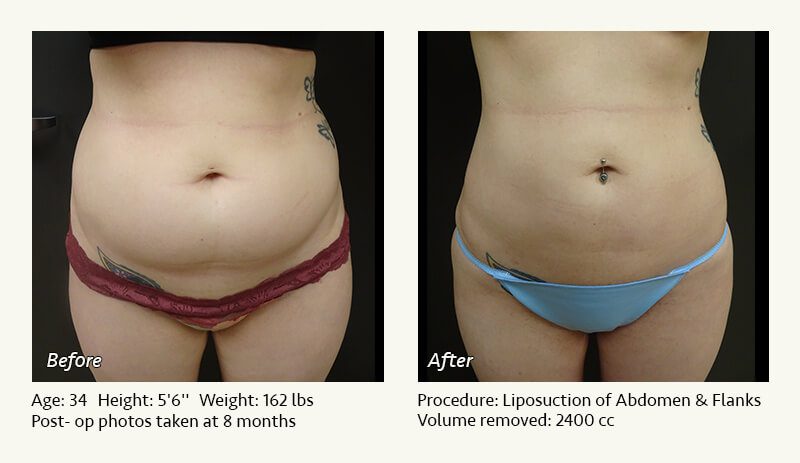 Cost Of Liposuction Austin