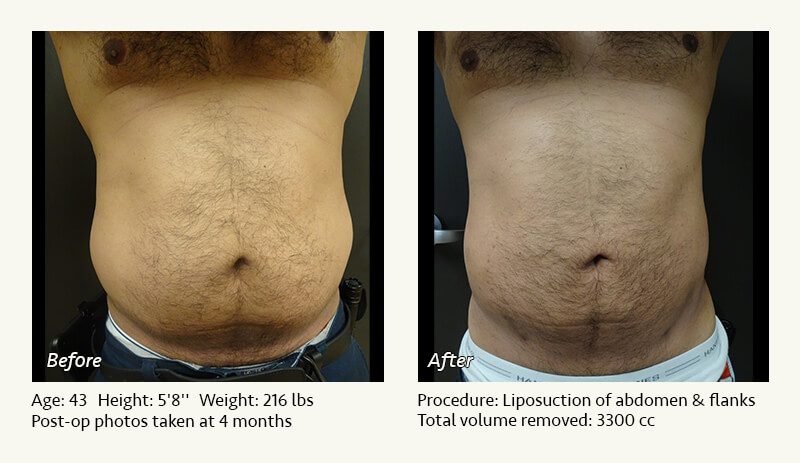 liposuction for obese men