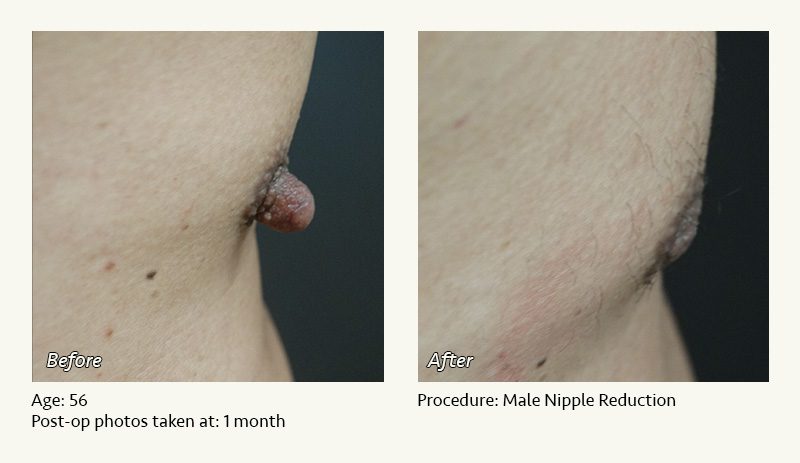 Male Nipple Reduction in Plano, TX - Patient 6