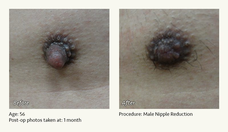 Male Nipple Reduction in Plano, TX - Patient 5