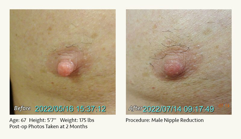 Male Nipple Reduction in Plano, TX - Patient 7