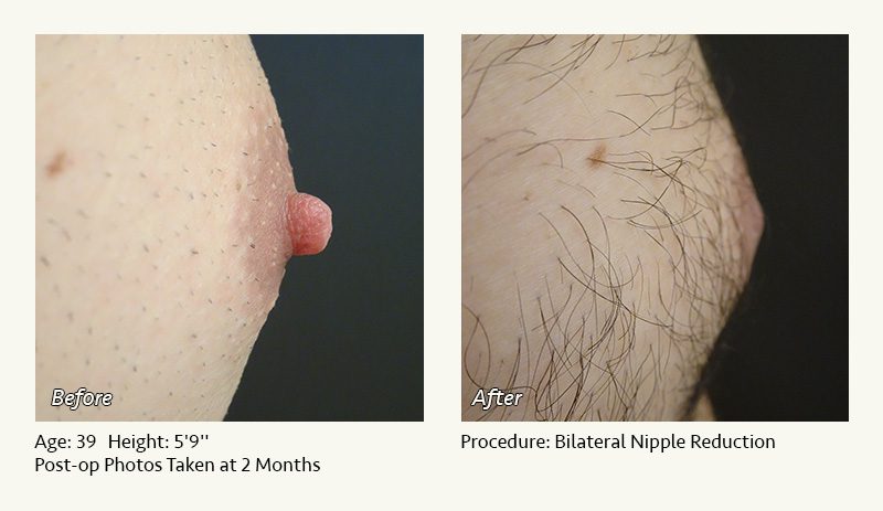 Male Nipple Reduction in Plano, TX - Patient 6