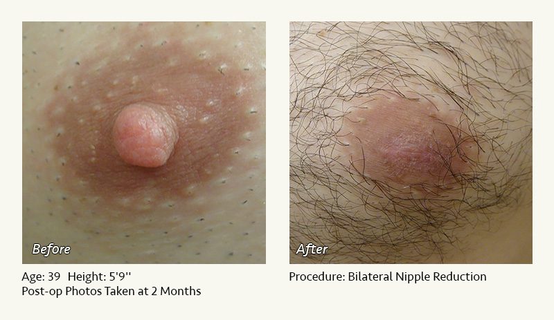 Male Nipple Reduction in Plano, TX - Patient 5