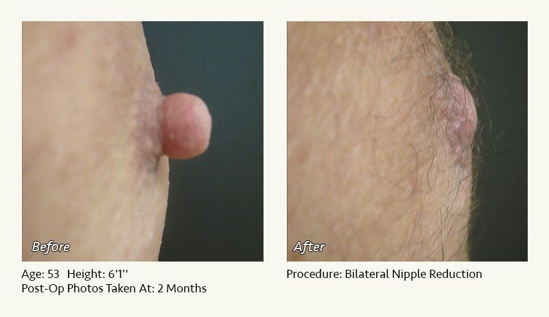 Nipple Reconstruction  The Centre for Cosmetic Surgery