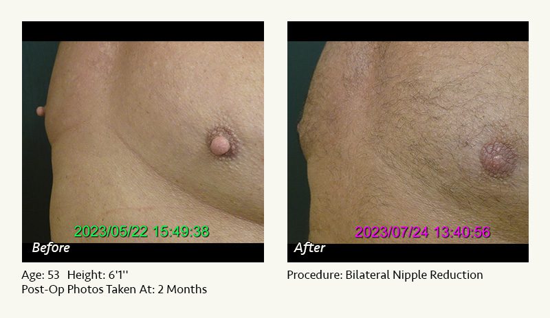 Male Nipple Reduction in Plano, TX - Patient 3
