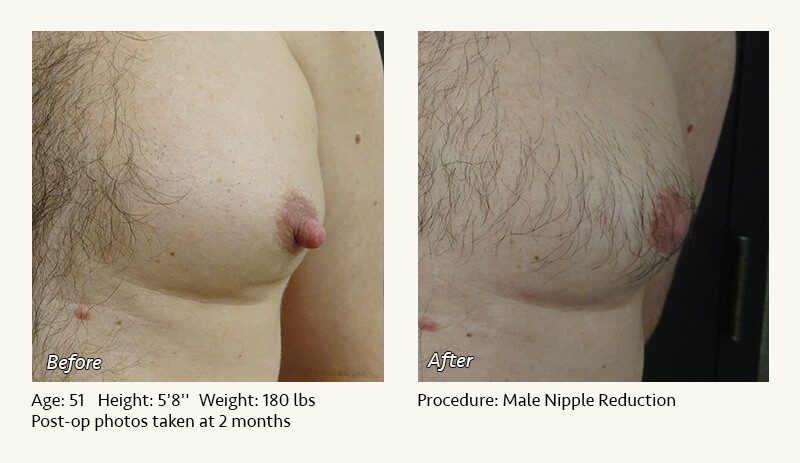 Male Nipple Reduction in Plano, TX - Patient 21