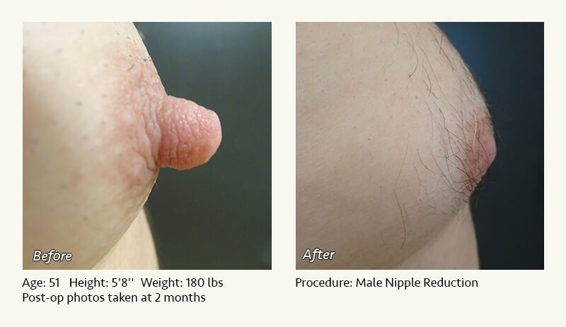 Male Nipple Reduction in Plano, TX - Patient 22
