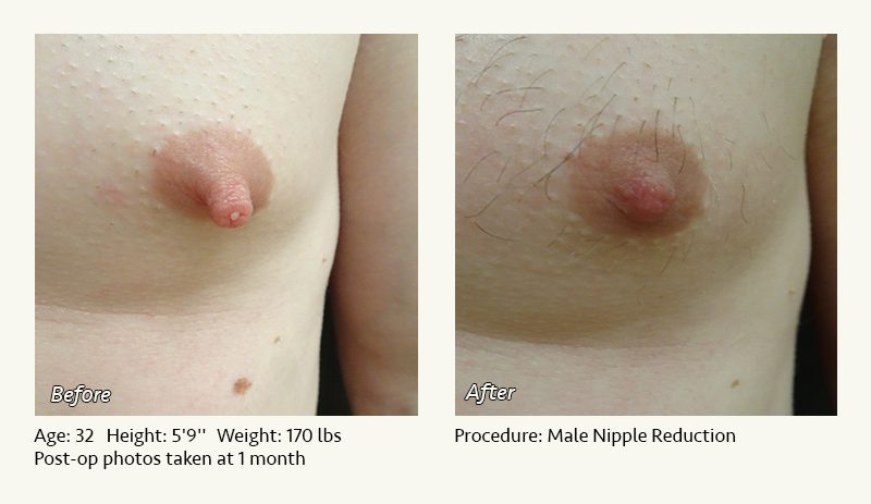 Male Nipple Reduction in Plano, TX - Patient 19