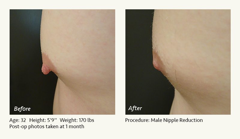 Male Nipple Reduction in Plano, TX - Patient 20