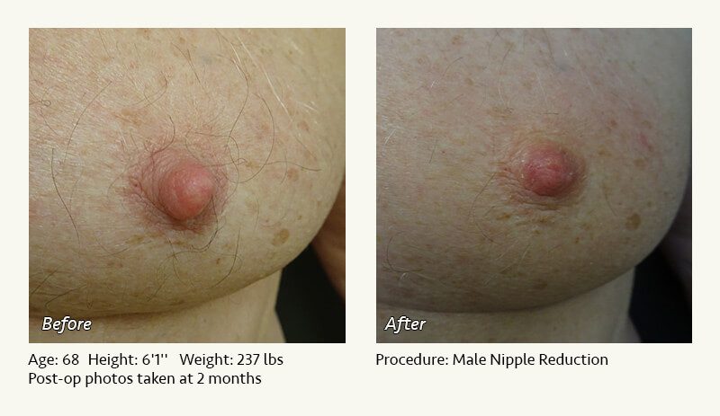 Male Nipple Reduction in Plano, TX - Patient 17