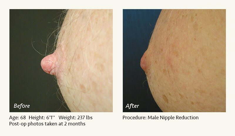 Male Nipple Reduction in Plano, TX - Patient 18