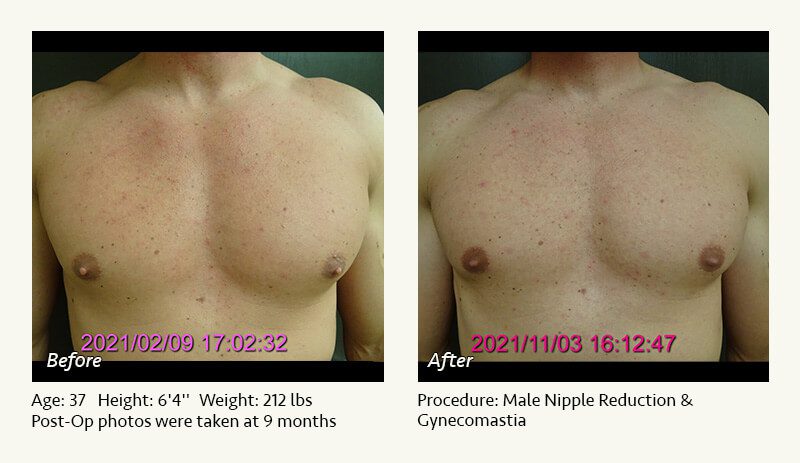 Male Nipple Reduction in Plano, TX - Patient 13