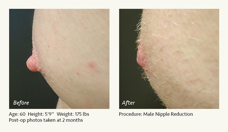 Male Nipple Reduction in Plano, TX - Patient 12