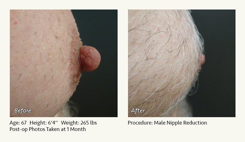 Male Nipple Reduction in Plano, TX - Patient 10