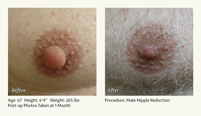 Male Nipple Reduction in Plano, TX - Patient 9