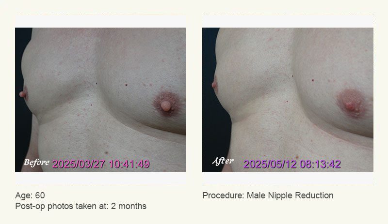 Male Nipple Reduction in Plano, TX - Patient 3